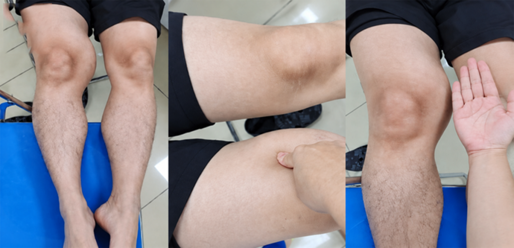 Đùi phình to như quả bóng suốt 1 năm, đi khám phát hiện ung thư hiếm gặp