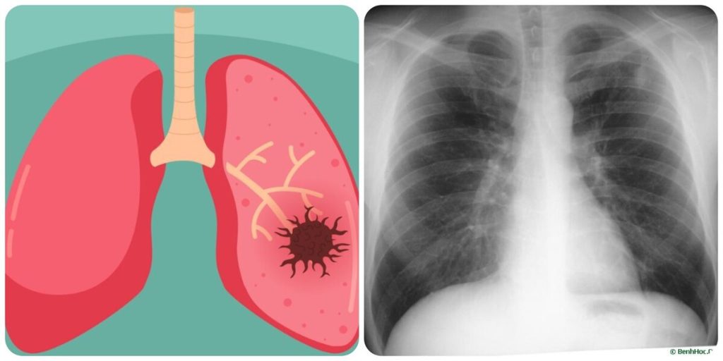 9 dấu hiệu ung thư phổi giai đoạn đầu